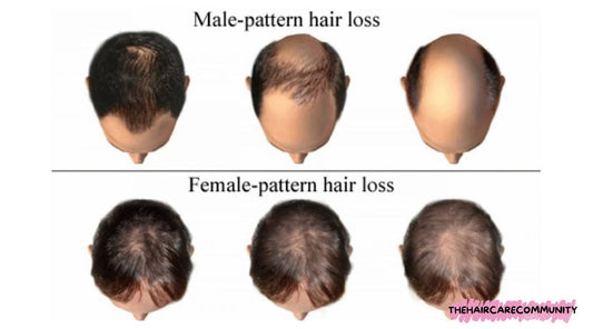 Know Your Enemy: Unveiling the Different Types of Hair Loss and Their Symptoms